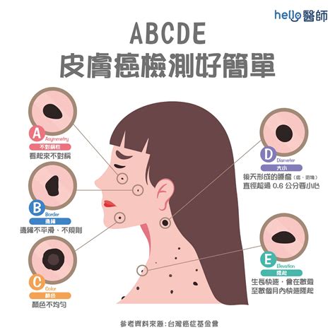 男生臉上很多痣|痣變大、痣多或長毛會變皮膚癌？認識痣的形成與原因